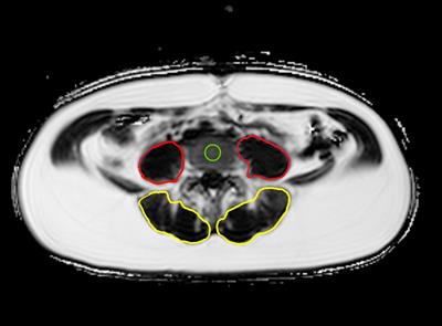 Associations of gestational diabetes and proton density fat fraction of vertebral bone marrow and paraspinal musculature in premenopausal women